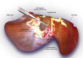 The rib cage partly protects the liver and cannot be felt if you were to touch it. Normal Liver Anatomy Sibulesky 2013 Clinical Liver Disease Wiley Online Library