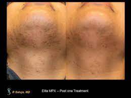 Wellington's most popular destination for laser hair removal. Laser Hair Removal Botox Wellington Wellington Cosmetic Clinic