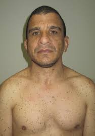 LEPOARD syndrome: A report of a case with a novel PTPN11 mutation