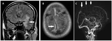 Herpes simplex encephalitis occurs as 2 distinct entities: Herpes Simplex Virus Hsv Encephalitis In A Young Man An Unusual Course Bmj Case Reports