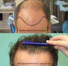 Our grafts are bigger, stronger and produce more hair. Medical Hair Restoration Hair Replacement Hair Transplant Hair Transplantation California Ca