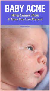 Never put acne medicine or acne wash on your baby's skin, unless your child's dermatologist or pediatrician recommends it. 8 Baby Acne Ideas Baby Acne Acne Newborn Acne