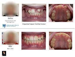 Pin On Child Early Orthodontic Treatment Before And After