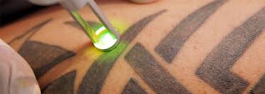 Lazerle Dovme Silme Q Switched Nd Yag Lazer Dr Asli Eralp