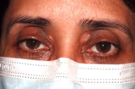 Image result for xanthelasma of eyelid