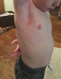 Molluscum contagiosum is a common condition where small warty bumps (mollusca) appear on the skin. A Natural Home Remedy To Treat Your Child S Molluscum Contagiosum Wichita Mom