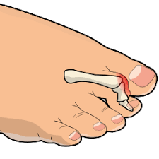 Image result for Hammer toe