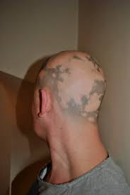 Turned into alopecia universalis.lost everything. Hair Regrowth From Hair To Eternity Page 2