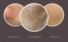 Cải thiện nám da