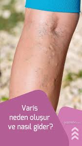 Varis Nedir Varis Neden Olusur Ve Nasil Gider En Etkili Varis Gideren Yontemler Varis Vucut Bakimi Saglik Bakim