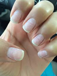 Updated on june 30, 2011. Can Acrylic Nails Be Removed