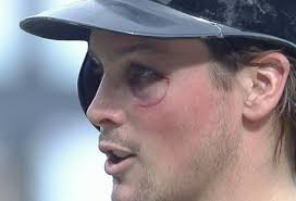 Travis Snider has huge black eye after punch from Martin Maldonado