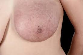 Orange peel appearance of the breast. Breast Cancer Gynecology And Obstetrics Msd Manual Professional Edition