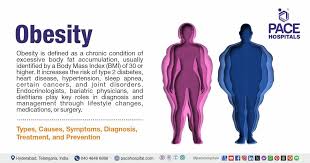 Image result for Obesity