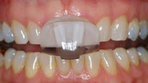 If your guard is not cleaned if you don't want to use denture or mouthguard cleaners, you can also give your night guard a deep clean with products you already. Nti Device For Tooth Wear And Headache Prevention In Kingston London