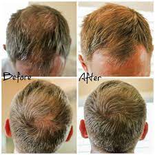 Hair Thinning And Hair Loss What S A Man To Do Clever Housewife Hair Loss Treatment Hair Transplant Women Hairstyles For Thin Hair