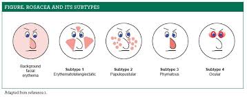 Relieving Rosaceas Redness Key Otc And Prescription Products