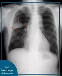 Image result for lung cancer xray