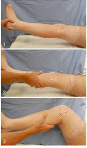 Image result for Pivot Shift Test