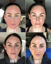 According to dermascope, a professional skin care journal, microneedling and chemical peels produce better results as complementary treatments when administered 4 to 6 weeks apart. My Experience W Microneedling Why I M Obsessed Paleomg
