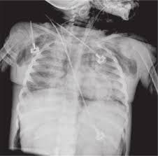 Subcutaneous emphysema towards bilateral axillary region,...