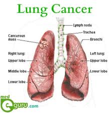 If you're living with lung cancer, you may, at times, experience a loss of appetite, as well as difficulty with chewing and swallowing, according to the roy castle lung cancer foundation. Lung Cancer Overview Lung Cancer Symptoms Medegurumed E Guru