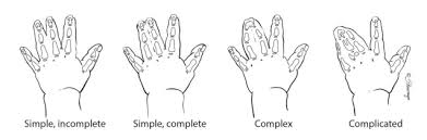 Poland syndrome is a rare, congenital defect that is characterized by: Syndactyly