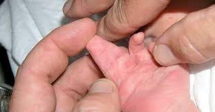 The thumb is, well, the thumb, too. Webbing Of The Fingers Causes And Treatments