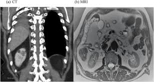 We explain the details and differences between ct scans and mris, and help you weigh the benefits and risks of. Ct Scan And Mri Showing Right Renal Lesions A Ct Scan Showing A Download Scientific Diagram