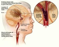 Τα αγγειακά εγκεφαλικά επεισόδια (αεε) προκαλούν βλάβη του εγκεφάλου που οφείλεται σε διακοπή της παροχής αίματος σε μια περιοχή (ισχαιμικό αεε) ή σε . Iatwr O Giatros 8erapeyths To Aggeiako Egkefaliko Epeisodio Aee