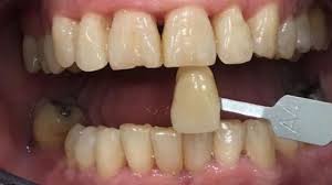 Check spelling or type a new query. Blanqueamiento Dental Philips Zoom Por 349 Caredent