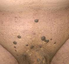 Image result for genital warts