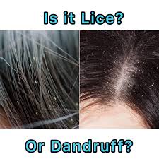 Image result for lice vs dandruff