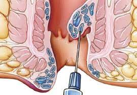 As this condition can be extremely painful, it is only natural that you ask yourself: Hemorrhoids The Definitive Guide To Medical And Surgical Treatment Consult Qd