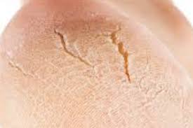 Crevasses Au Talon Quoi Faire Abc Naturopathie
