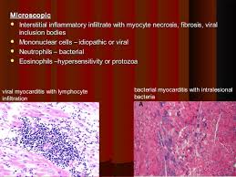 N myocarditis is an inflammatory disease of the heart muscle, diagnosed by established histological n the true incidence of myocarditis is unknown because the majority of cases are asymptomatic. 8 Disease Of Myocardium