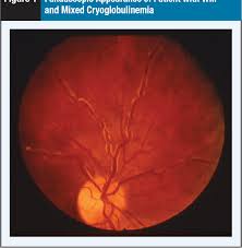 Image result for Hyperviscosity Syndrome