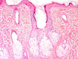 Image result for Sebaceous Gland