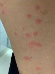 Wann kommen bettwanzen dafür in frage? Konnten Das Bettwanzenbisse Sein Stich Insektenstich Bettwanzen