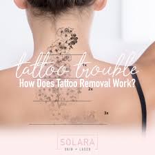 How exactly does tattoo removal work? Laser Tatoo Removal Archives Solara Skin Laser