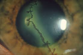 Herpes simplex virus (hsv) keratitis is the most frequent cause of blindness due to corneal disease in the united states and the most common source of infectious. Herpes Simplex Keratitis Eye Disorders Msd Manual Professional Edition