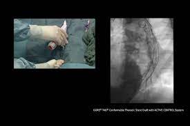 Case video: Saccular aneurysm with suspicion of contained rupture | Gore  Medical
