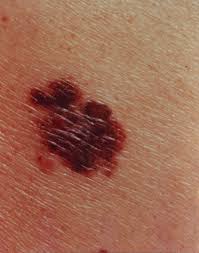 It affects people of all races, genders and ages, which is why it's absolutely critical for americans to learn about. Skin Cancer Melanoma Red And Brown Lesion 1 Image Details Nci Visuals Online