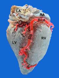 Documented coronary ischemia secondary to coronary artery compression when. Posterior View Of The Heart Moderate Right Coronary Dominance Ra Download Scientific Diagram