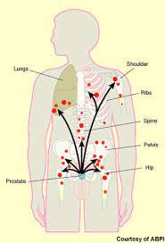 About 80 percent of the time prostate cancer cells metastasize, or spread, they will spread to bones, such as the hip, spine, and pelvis bones. Zytiga Abiraterone Acetate Treatment Of Metastatic Castration Resistant Prostate Cancer Mcrpc Clinical Trials Arena