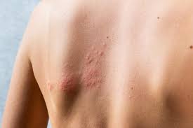 Image result for shingles