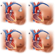 It implements several apis for controlling resources. Innovations In Pacemakers A Dual Chamber Pacemaker With Ventricular Download Scientific Diagram