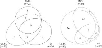 Our team works hard to combine diverse. Longitudinal Macular Ganglion Cell Inner Plexiform Layer Measurements To Detect Glaucoma Progression In High Myopia American Journal Of Ophthalmology
