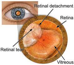 This can cause fluid in your eye to seep underneath your retina and separate it from the back wall of your eye. Retina Health Center Retinal Tear And Detachment