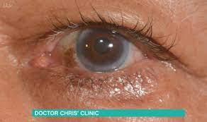 High Cholesterol Symptoms This Morning Dr Chris Warns Of Having A Grey Ring In Your Eye Express Co Uk